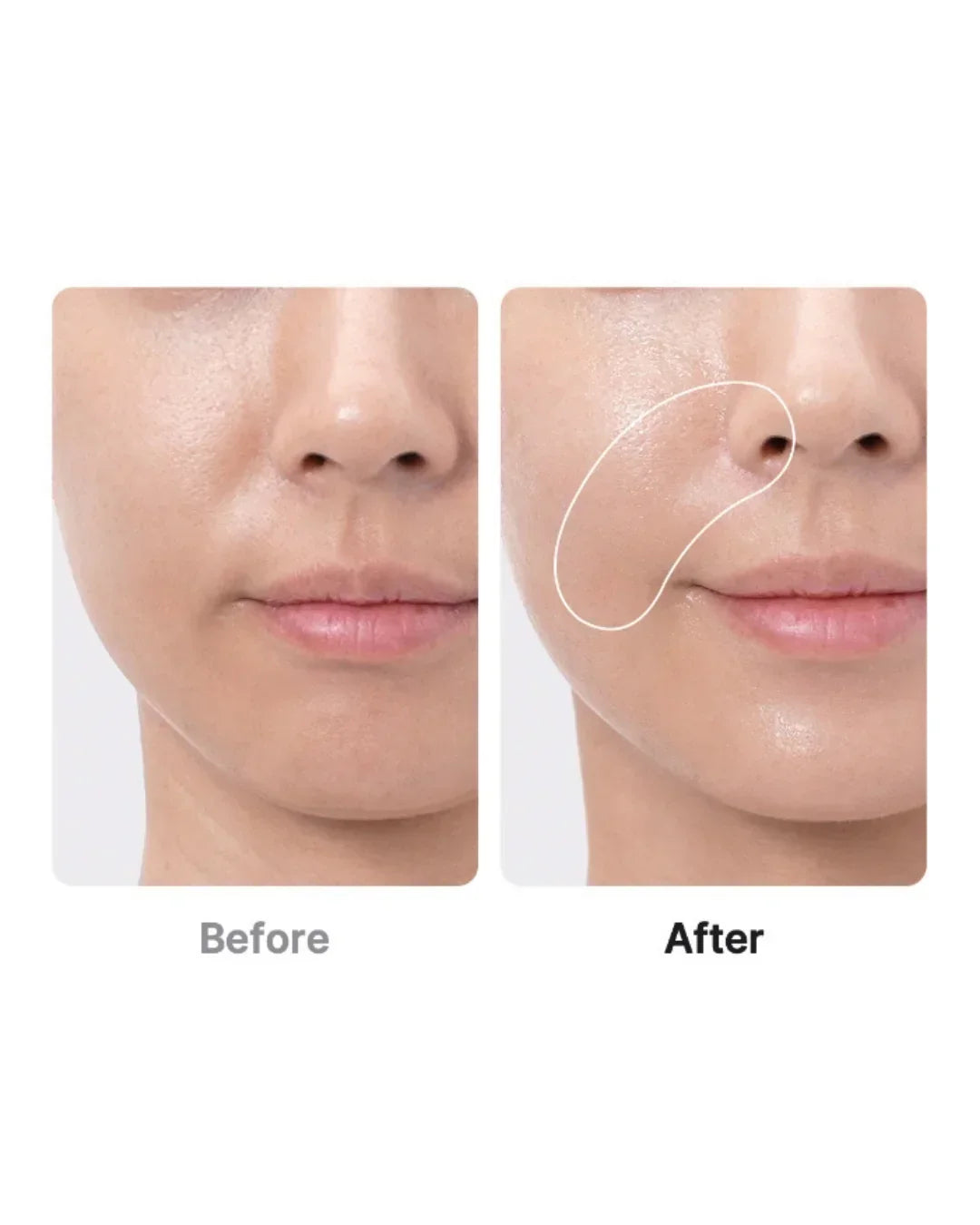 Korean beauty device before and after result on woman's face, smoother skin texture shown.