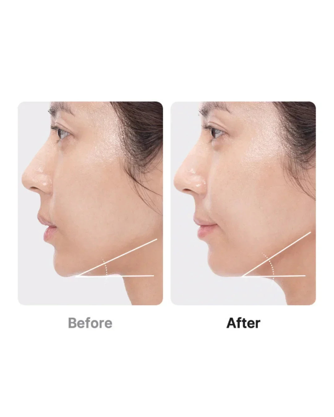 Side-by-side before and after of woman's jawline, showcasing Korean beauty device results at Malkn.