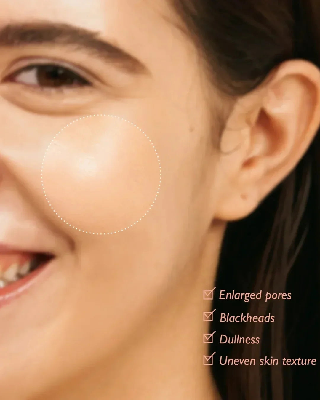 Close-up of smiling woman’s cheek highlighting enlarged pores, blackheads, dullness, and uneven skin texture