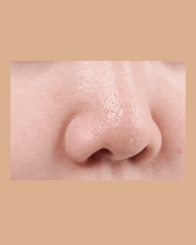Close-up of a nose with visible skin pores, showing before and after results of blackhead removal treatment